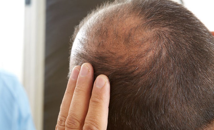 middle-aged man concerned with hair loss. baldness